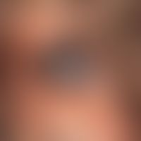 Melanoma, malignant, nodular, solitary, solid, sharply defined, surface smooth, non-hairy, black ...