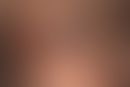 Melanoma, malignant, nodular, solitary, solid, sharply defined, surface smooth, non-hairy, black ...