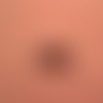 Melanoma, malignant, nodular. Malignant melanoma of the primary nodular type. In the last months ...