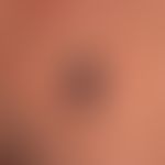 Melanoma, malignant, nodular. Malignant melanoma of the primary nodular type. In the last months ...