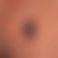 Melanom, malignes, noduläres. Malignes Melanom vom primär-nodulären Typ.&nbsp; In den letzten Mon...