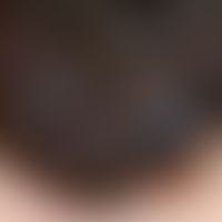 Melanom malignes noduläres.&nbsp; Auflichtmikroskopie aus dem Randbezirk des Knotens. homogene bl...