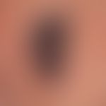 melanoma, malignant, nodular. malignant melanoma of the primary-nodular type (detailed picture). ...
