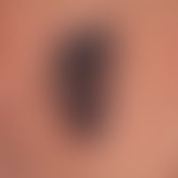 melanoma, malignant, nodular. malignant melanoma of the primary-nodular type (detailed picture). ...