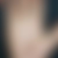 Scarlet fever. 12-year-old patient presents with a discreet erythema of both palms. At the transi...