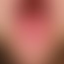 Scarlet tongue: In a 4-year-old boy with scarlet fever on the 5th day after the onset of the dise...