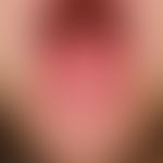 Scharlachzunge. Bei einem 4-jährigen Jungen mit Scharlach zeigen sich am 5. Tag nach Krankheitsbe...
