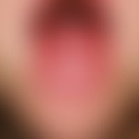 Scharlachzunge. Bei einem 4-jährigen Jungen mit Scharlach zeigen sich am 5. Tag nach Krankheitsbe...