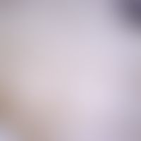 Sleeping sickness. Glossina wing. Typical for the glossines is the hatchet-shaped central cell in...