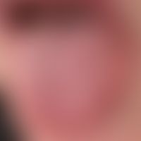 Suddenly appearing, laterally localized on the left tongue, glassy-looking, approx. 0.8 mm in dia...