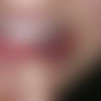 Mucus granuloma, following a painful bite wound, reddish-bluish, glassy, soft, spherical, about 1...