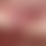 Schleimgranulom. Zustand nach Extraktion des linken oberen Eckzahnes bei einem 83-jährigen Patien...