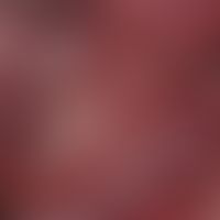 Mucus granuloma (Ranula). 0.2 cm large, chronic stationary, not painful, firm, smooth, white elev...