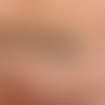 Dirt tattoo, black-blue deposit measuringapprox. 1 cm x 0.8 cm in the area of the eyebrow of a 79...