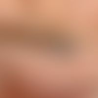 Dirt tattoo, black-blue deposit measuringapprox. 1 cm x 0.8 cm in the area of the eyebrow of a 79...