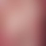 Schuppe. Schuppung bei Pustulosis acuta generalisata [AGEP]. Abheilungszustand einer AGEP mit Abs...