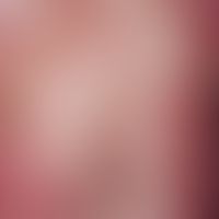 Schuppe. Schuppung bei Pustulosis acuta generalisata [AGEP]. Abheilungszustand einer AGEP mit Abs...