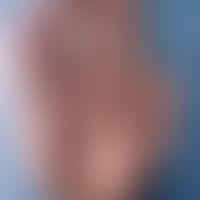 Schwannom: multiple, im Verlauf der sensiblen Fingernerven angeordnete, 1-2 cm große, schmerzlose...