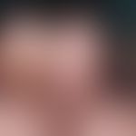 Schwannom:&nbsp;1-2 cm große, schmerzlose, derbe Plaques und Knoten bei einem 40-jährigen Mann.
