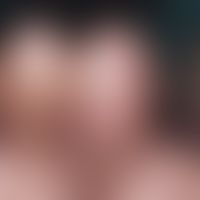 Schwannom:&nbsp;1-2 cm große, schmerzlose, derbe Plaques und Knoten bei einem 40-jährigen Mann.
