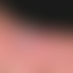 Swimming pool granuloma. general view: For several months, continuously growing, completely painl...
