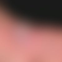 Swimming pool granuloma. general view: For several months, continuously growing, completely painl...