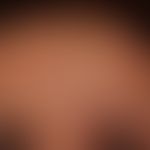 Sclérodermie en coup de sabre: streifige Induration und Verfärbung der Stirnhaut mit leichter Abs...