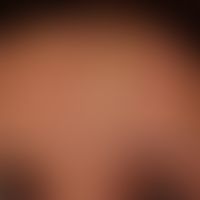 Scléroderma en coup de sabre: streaky induration and discoloration of the forehead skin with slig...