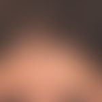 Sclérodermie en coup de sabre: seit Jahren zunehmende symptomlose Furchenbildung in Stirnmitte.
