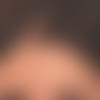 Scléroderma en coup de sabre: symptomless furrow formation in the middle of the foreheadhas been ...