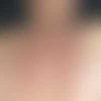 Scleroedema adultorum. extensive, board-like induration in the area of the upper back and neck. t...