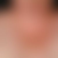 Scleroedema adultorum, extensive, board-like indurations in the region of the décolleté in a 65-y...