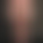 Sézary syndrome: 62-year-old patient. 1 year ago first skin changes with uncharacteristic moderat...