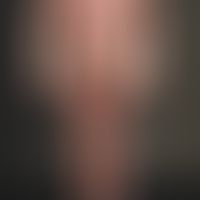 Sézary syndrome: 62-year-old patient. 1 year ago first skin changes with uncharacteristic moderat...