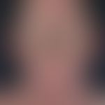 Sézary syndrome: extensive, less characteristic, scaly and massively itching and painful erythrod...