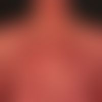 Sézary syndrome: universal redness with small bizarre recesses. small spotted scaling. massive it...