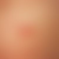 Scabies. Nahaufnahme: Lineare und hakenförmige, gerötete, infiltrierte Gänge. Starker Juckreiz im...