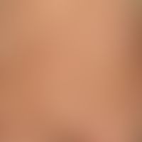 Scabies: dissseminated, fresh and older, erythematous papules, multiple scratch artifacts and ero...