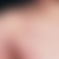 scabies. vein-shaped, rough papules with massive, especially nocturnal itching. larger plaques on...