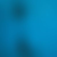Scleroderma, systemic. nail fold capillaroscopy, irregularly configured capillaries, chimney-shap...