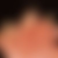 Scleroderma systemic: multiple sharply separated fingertip necroses.
