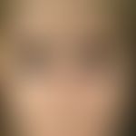 Scleroderma, systemic. smooth taut facial skin, distinct microstomy with retraction of the upper ...