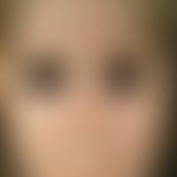 Scleroderma, systemic. smooth taut facial skin, distinct microstomy with retraction of the upper ...