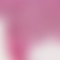 Scleroderma, systemic. Shapeless widened sclerotic dermis with atrophic eccrine sweat glands and ...