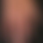 Scleroderma, systemic. Raynaud's syndrome (hypothermia and livid discoloration), slight doughy sw...