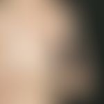 Sklerodermie, zirkumskripte. Unbehandelte, bandförmige, zirkumskripte Sklerodermie mit extremer A...