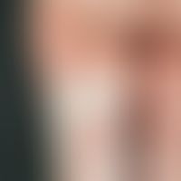 Scleroderma, circumscribed (plaque-type). Large circumscribed scleroderma with flat, little indur...