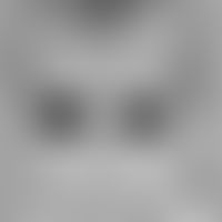 Sklerodermie, zirkumskripte. Verlaufsdokumentation, Bild 1: 5 jährige Patientin vor Beginn der Er...