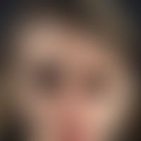 Sklerodermie, zirkumskripte. Verlaufsdokumentation, Bild 3: Neurologische (Fazialparese) und opht...