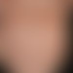 Sklerodermie zirkumskripte (Plaque-Typ/&nbsp;Variante: Atrophodermia idiopathica et progressiva) ...